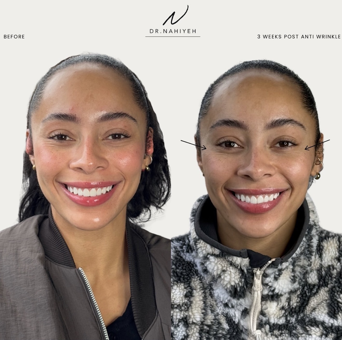 Anti-Wrinkle Top-Up — Crow's Feet Softening — image 1