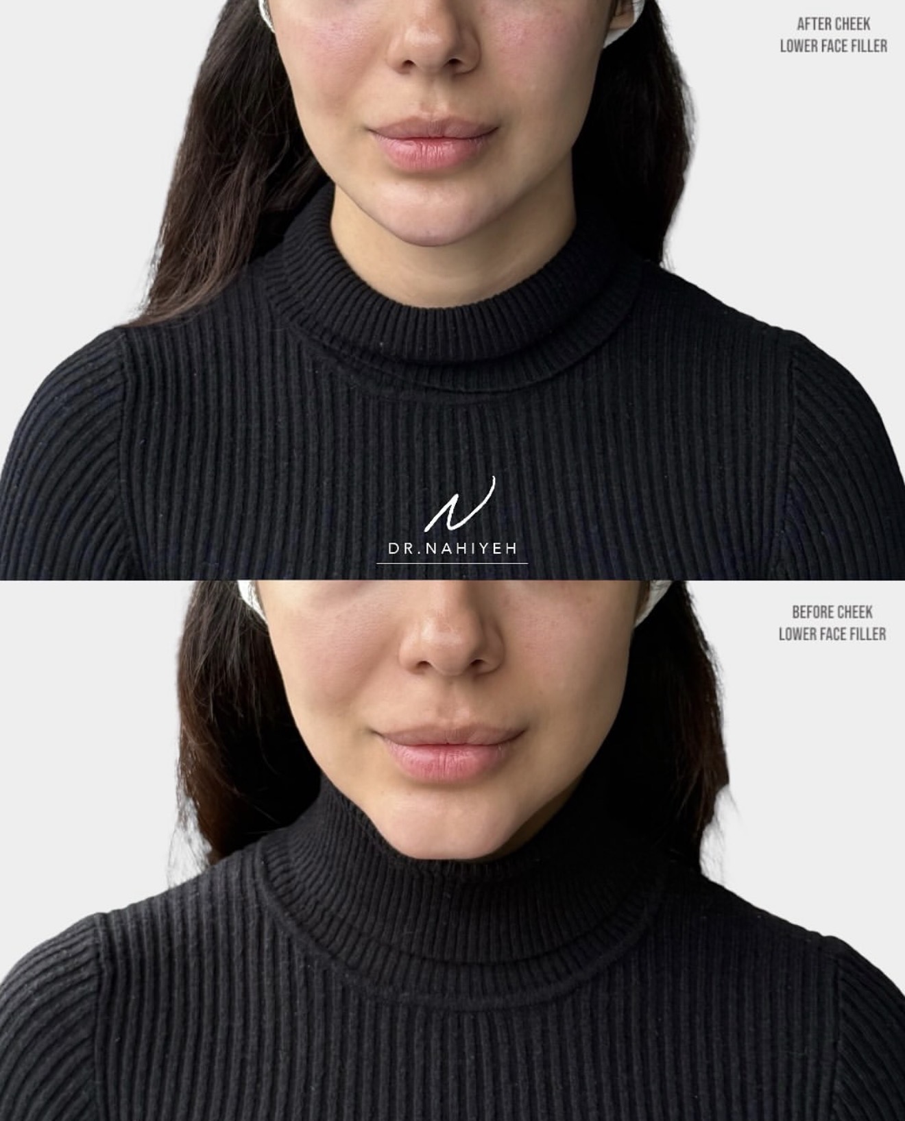 Cheek, Lower Face & Lip Refinement — image 1