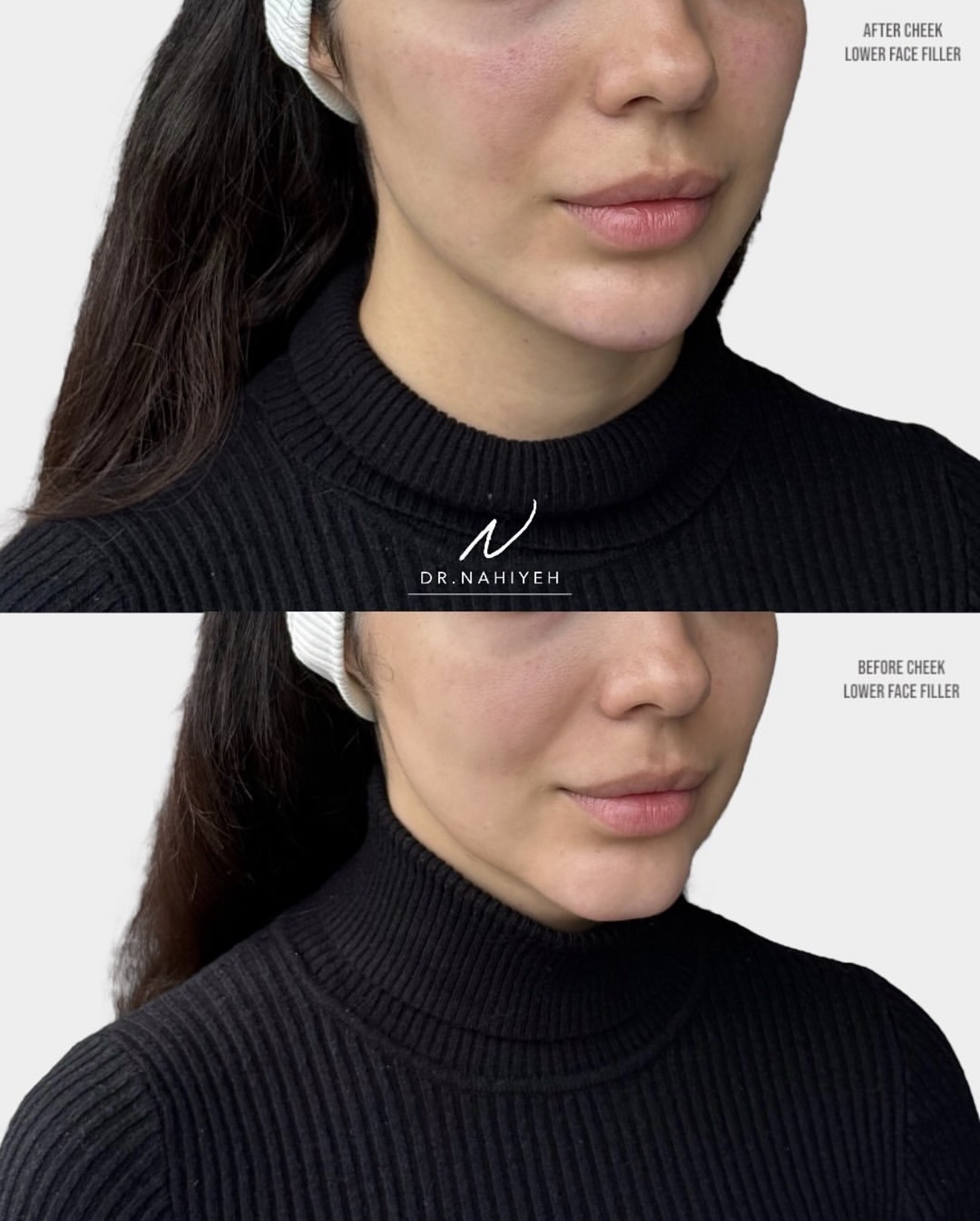 Cheek, Lower Face & Lip Refinement — image 2