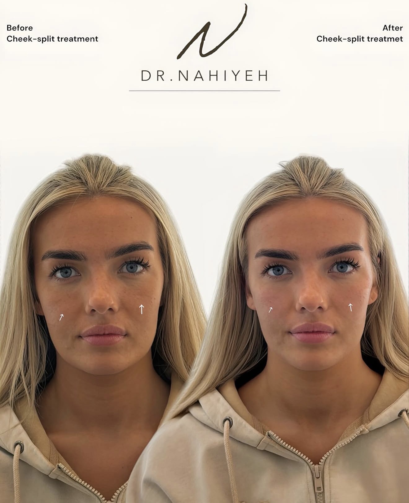 Cheek-Split Treatment — image 1