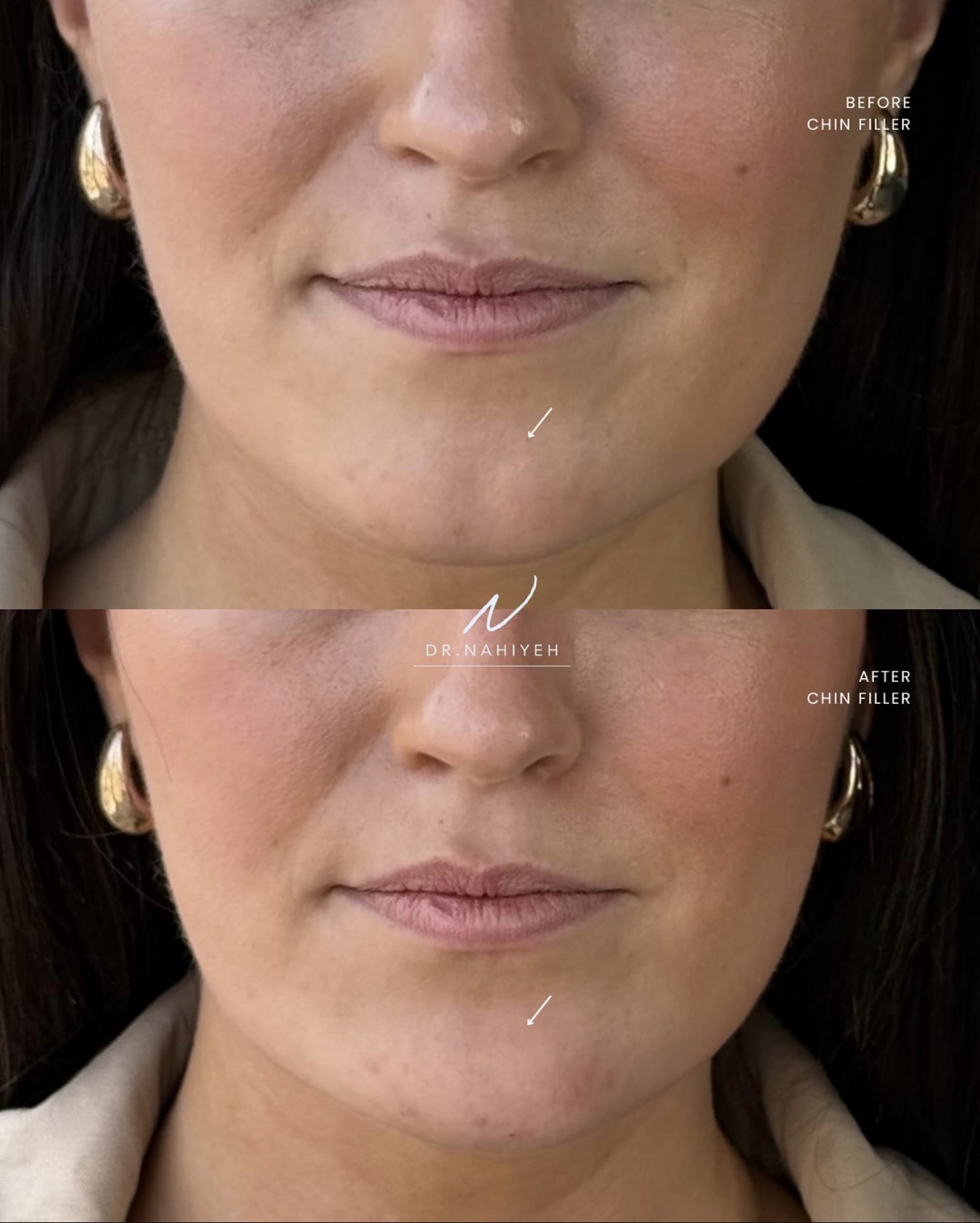 Chin Filler — Female Patient — image 1