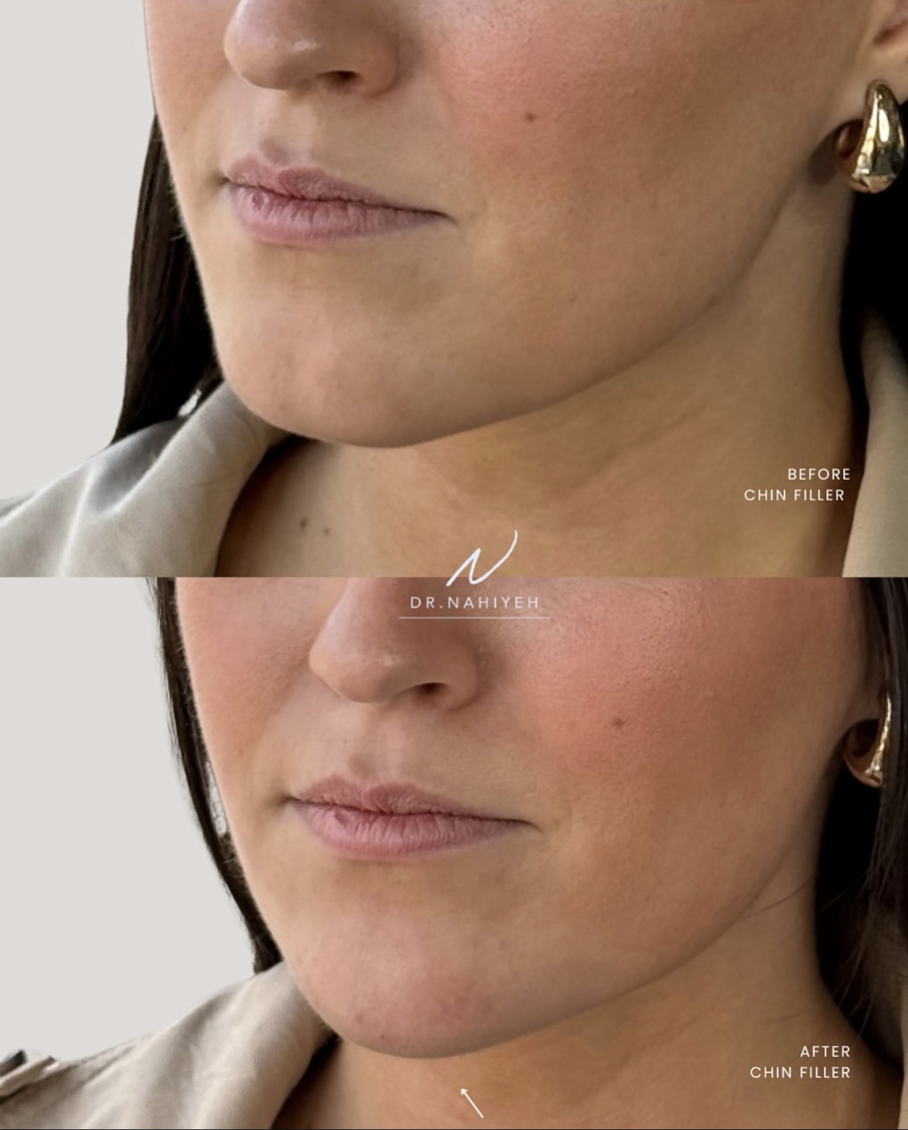 Chin Filler — Female Patient — image 2