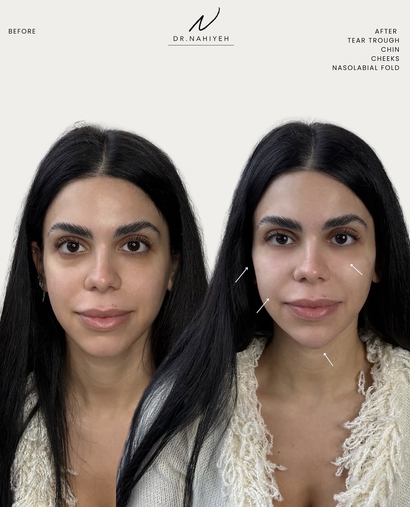 Full-Face Refinement — image 1