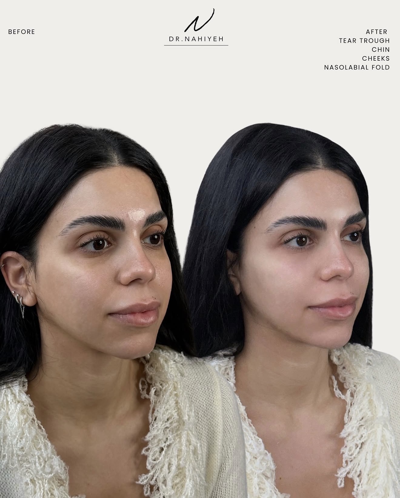 Full-Face Refinement — image 2