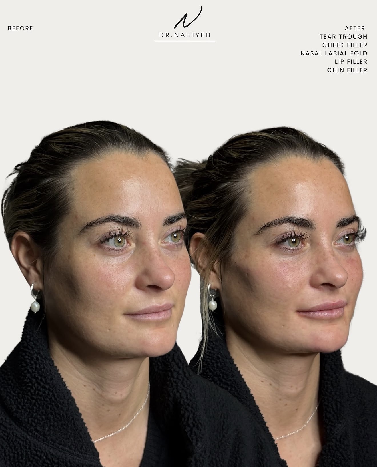 Full-Face Refinement — Patient III — image 1