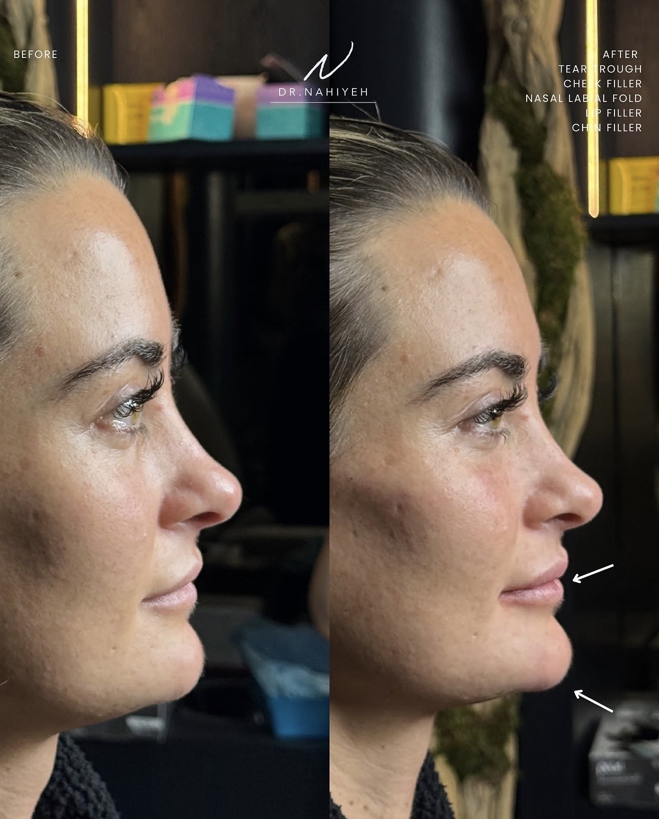 Full-Face Refinement — Patient III — image 2