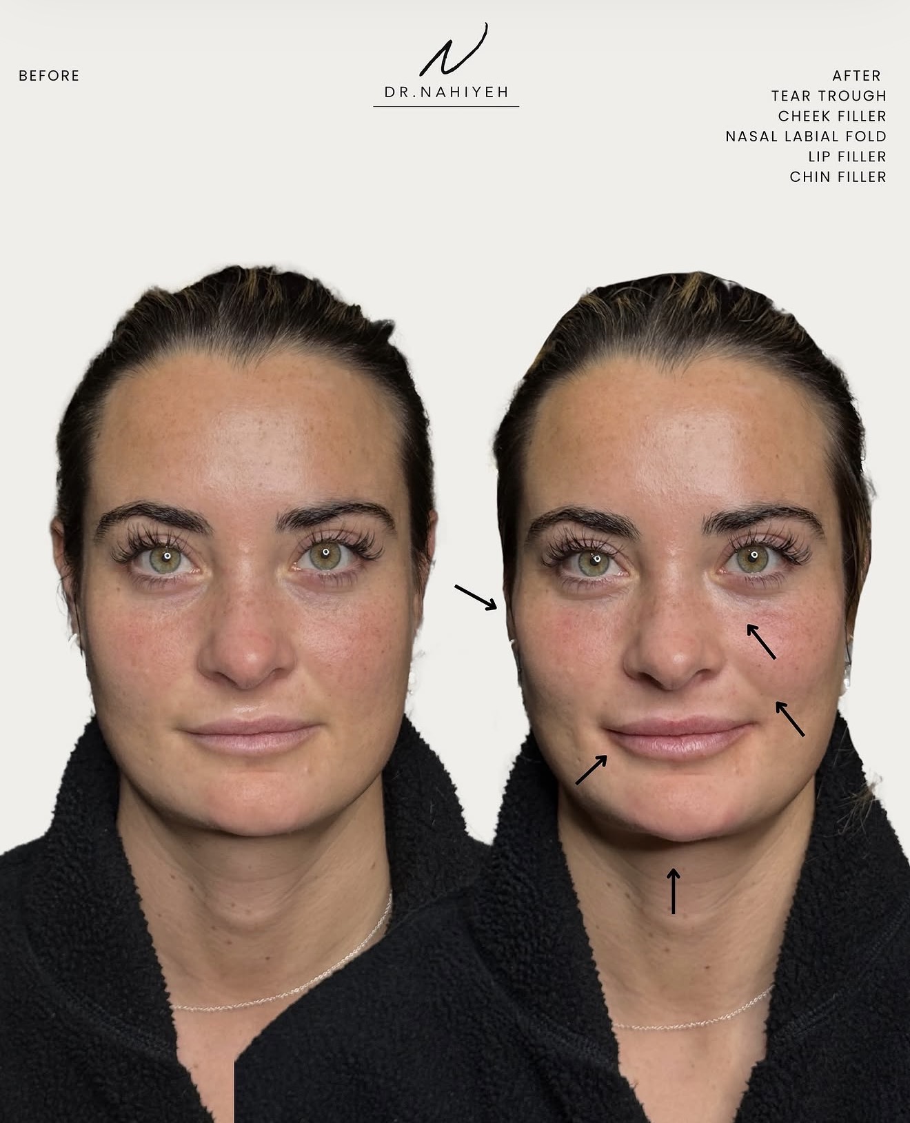 Full-Face Refinement — Patient III — image 3