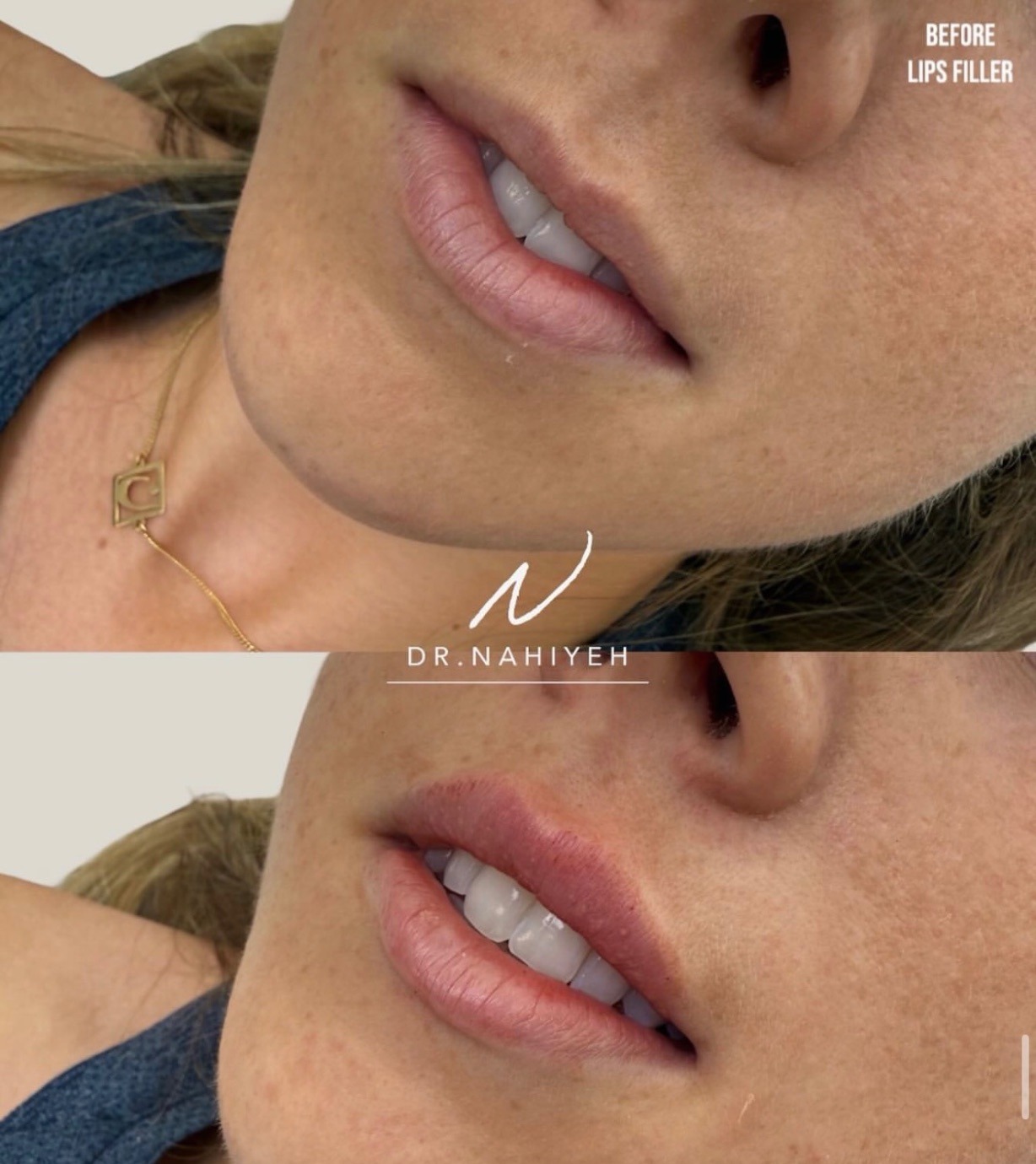 Lip Filler — image 1