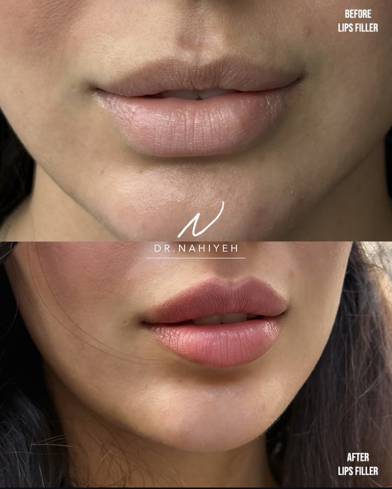 Before and after — Dr. Nahiyeh