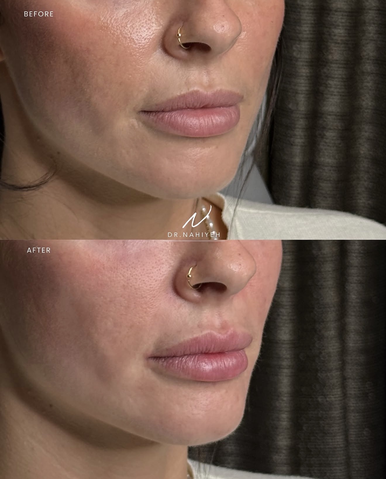 Tear Trough, Pyriform Fossa & Lip Filler — image 3