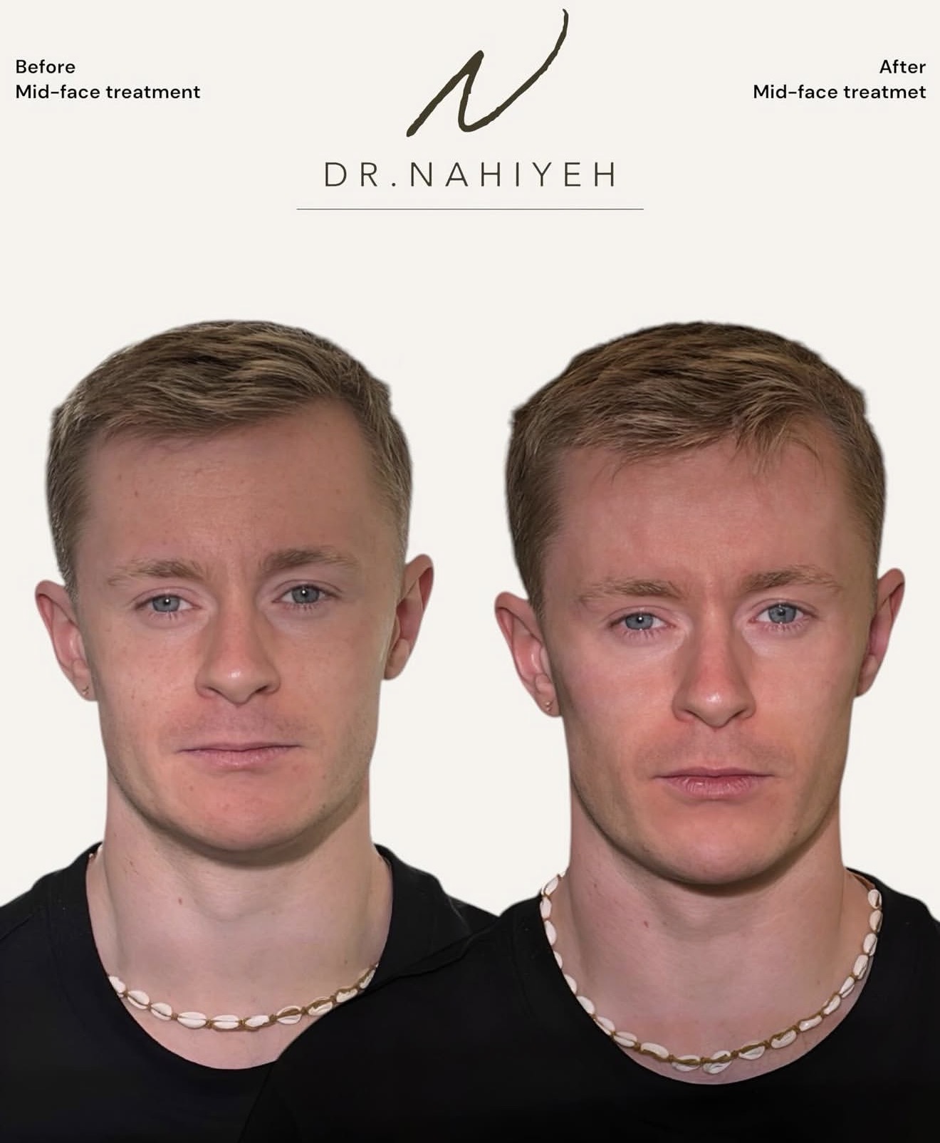 Before and after — Dr. Nahiyeh
