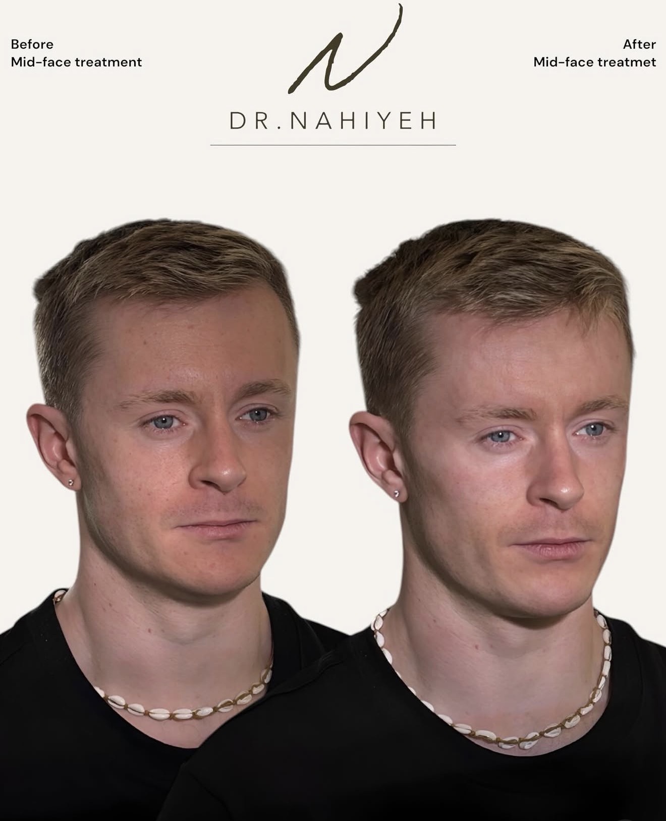 Mid-Face Treatment — image 2