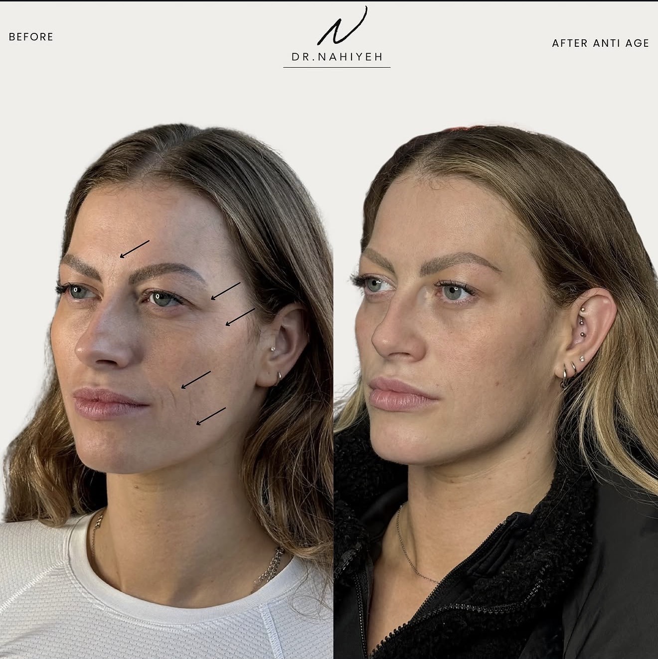 Mini Non-Surgical Lift — image 2