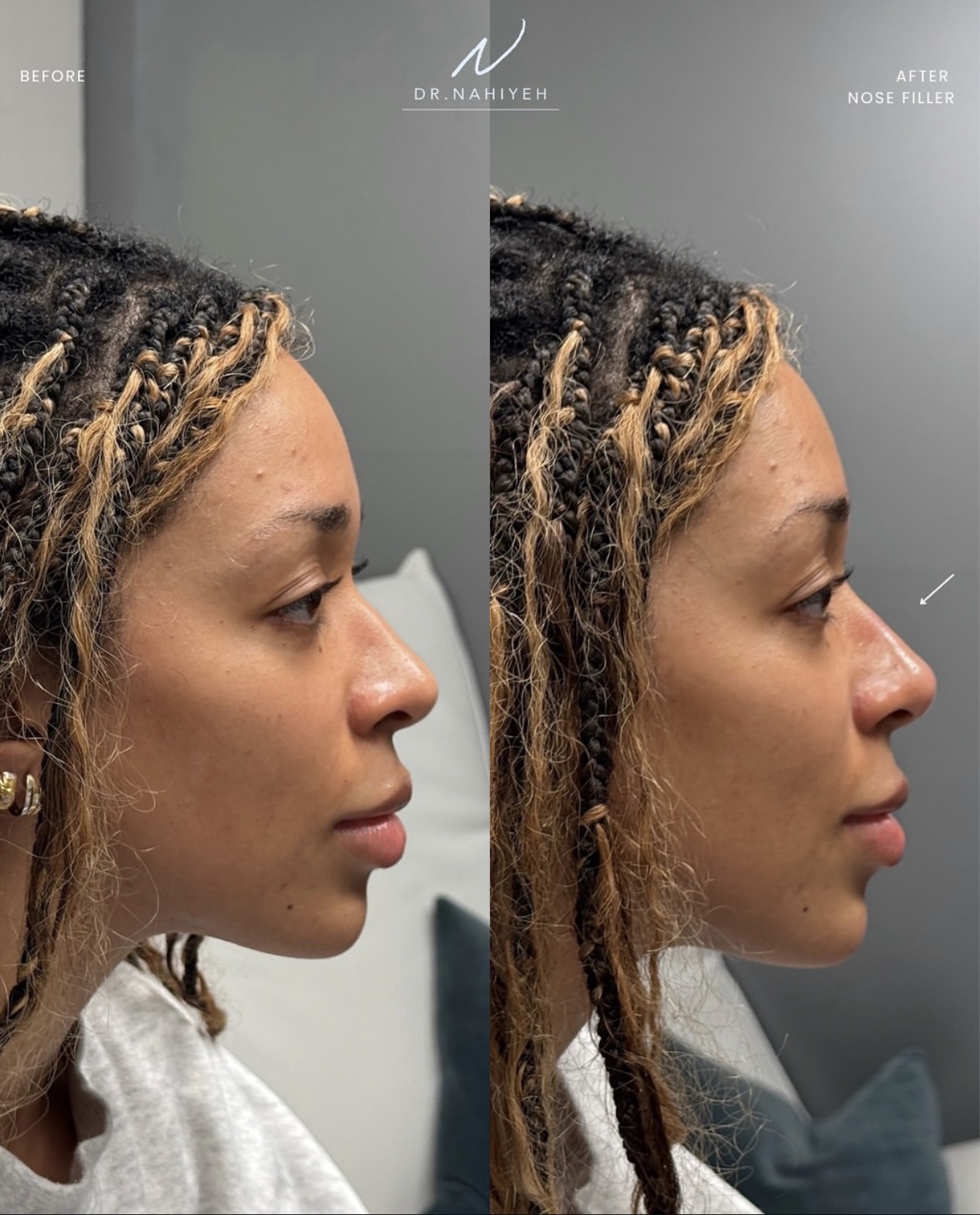 Non-Surgical Nose Filler — Female Patient — image 1