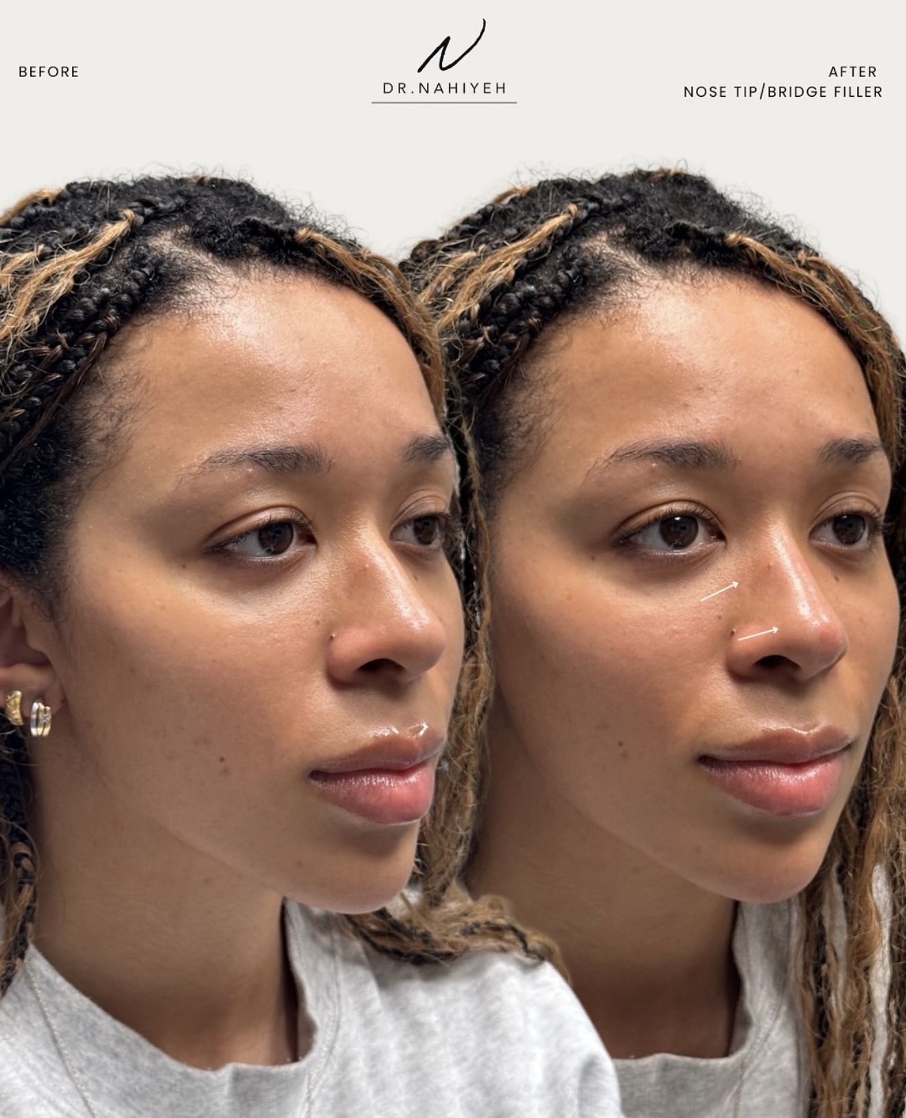 Non-Surgical Nose Filler — Female Patient — image 2