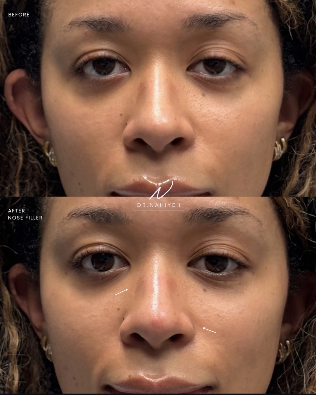 Non-Surgical Nose Filler — Female Patient — image 3
