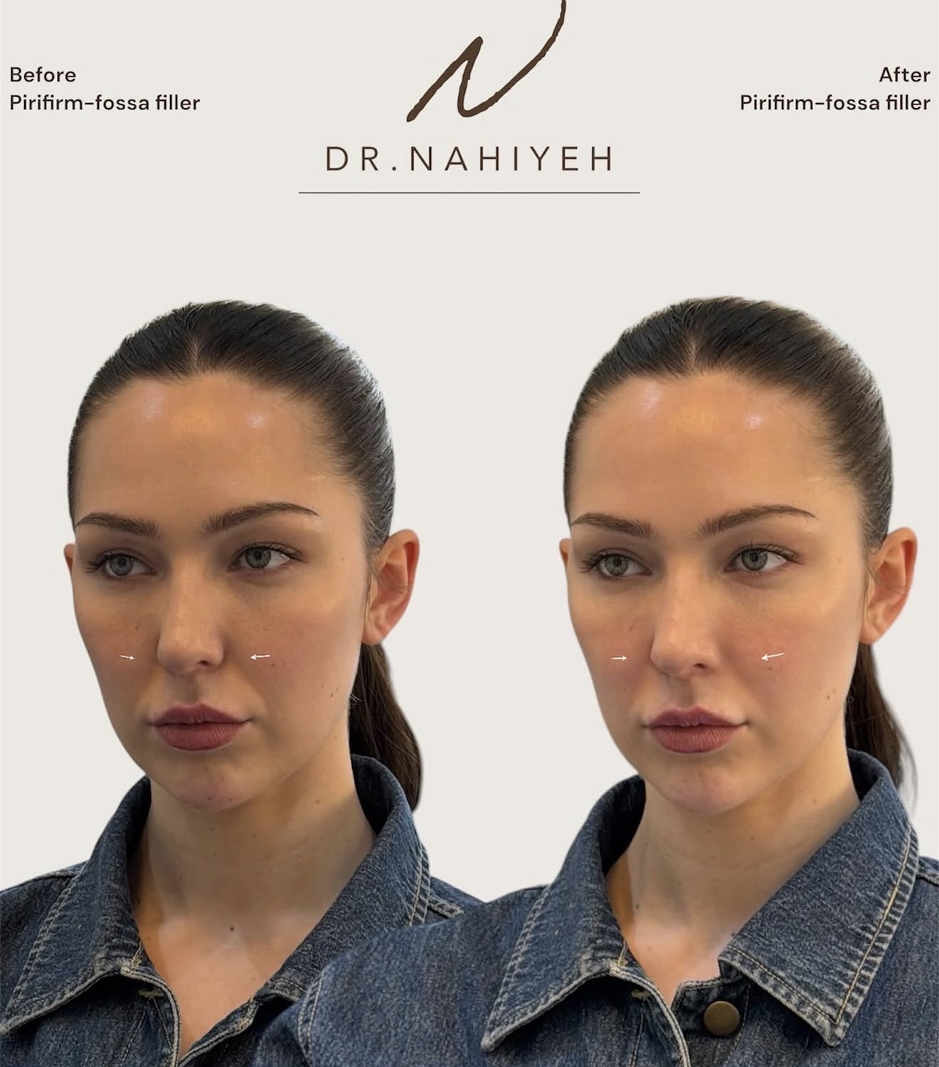Pirifirm-Fossa Filler — image 1
