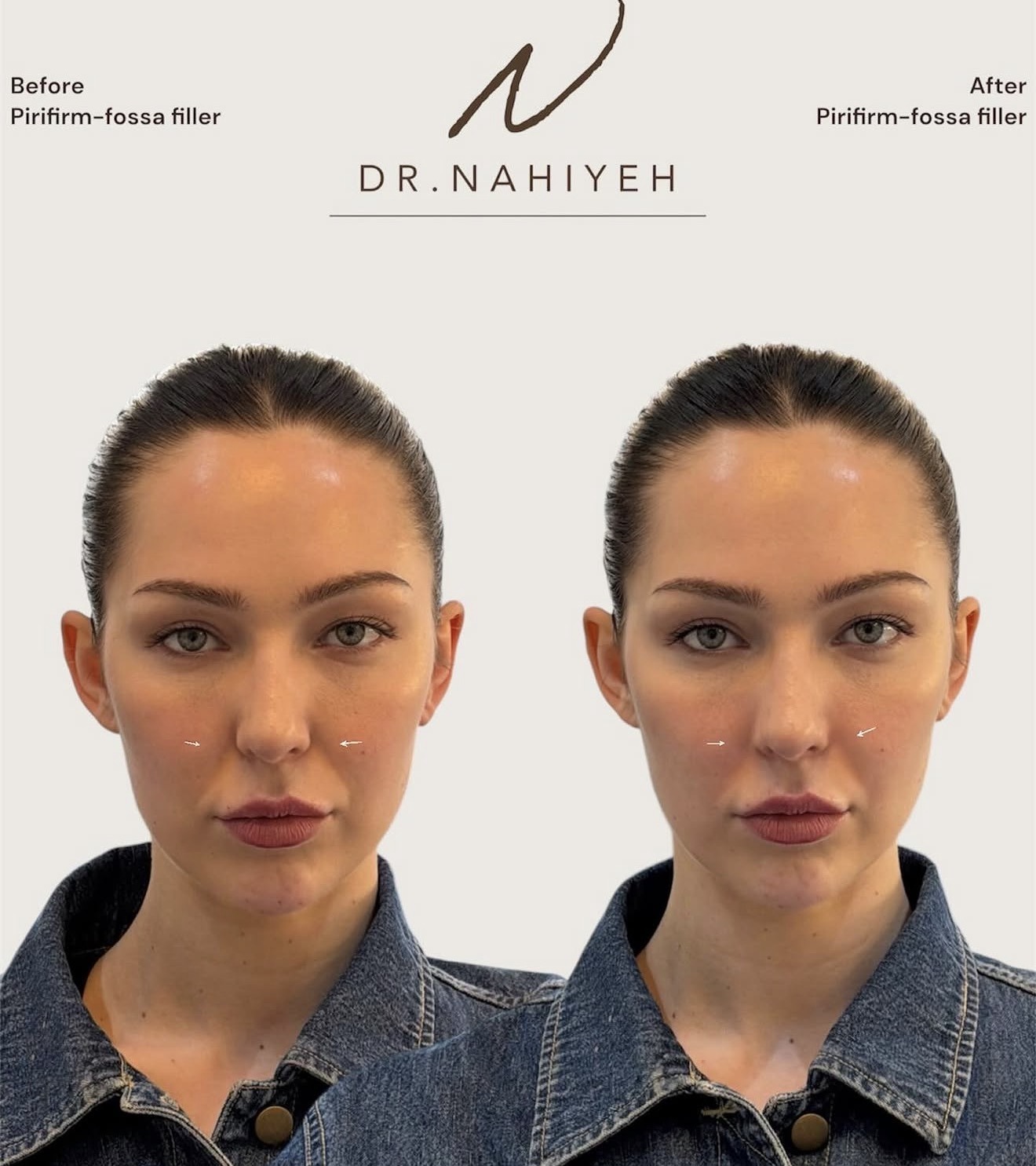 Pirifirm-Fossa Filler — image 2