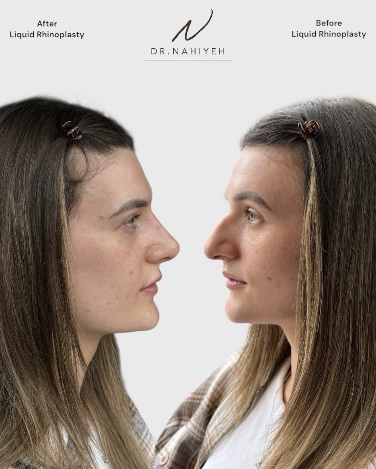 Liquid Rhinoplasty — image 1