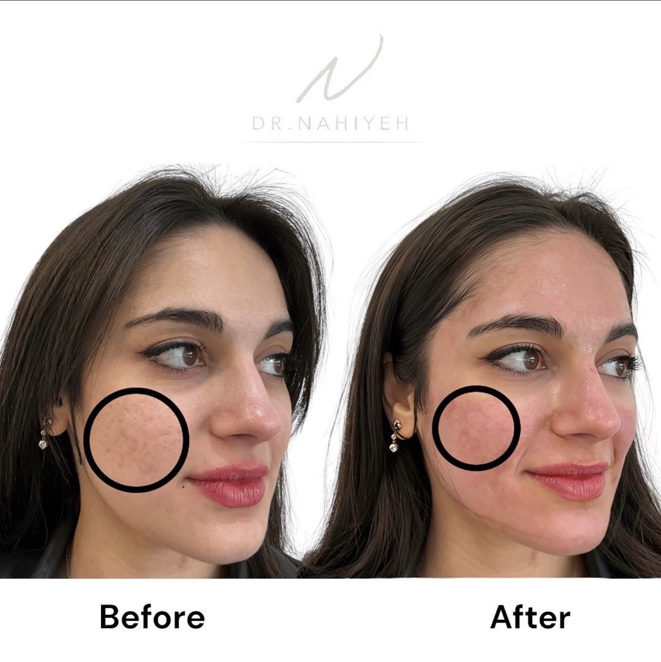 Acne Scar Treatment — image 1