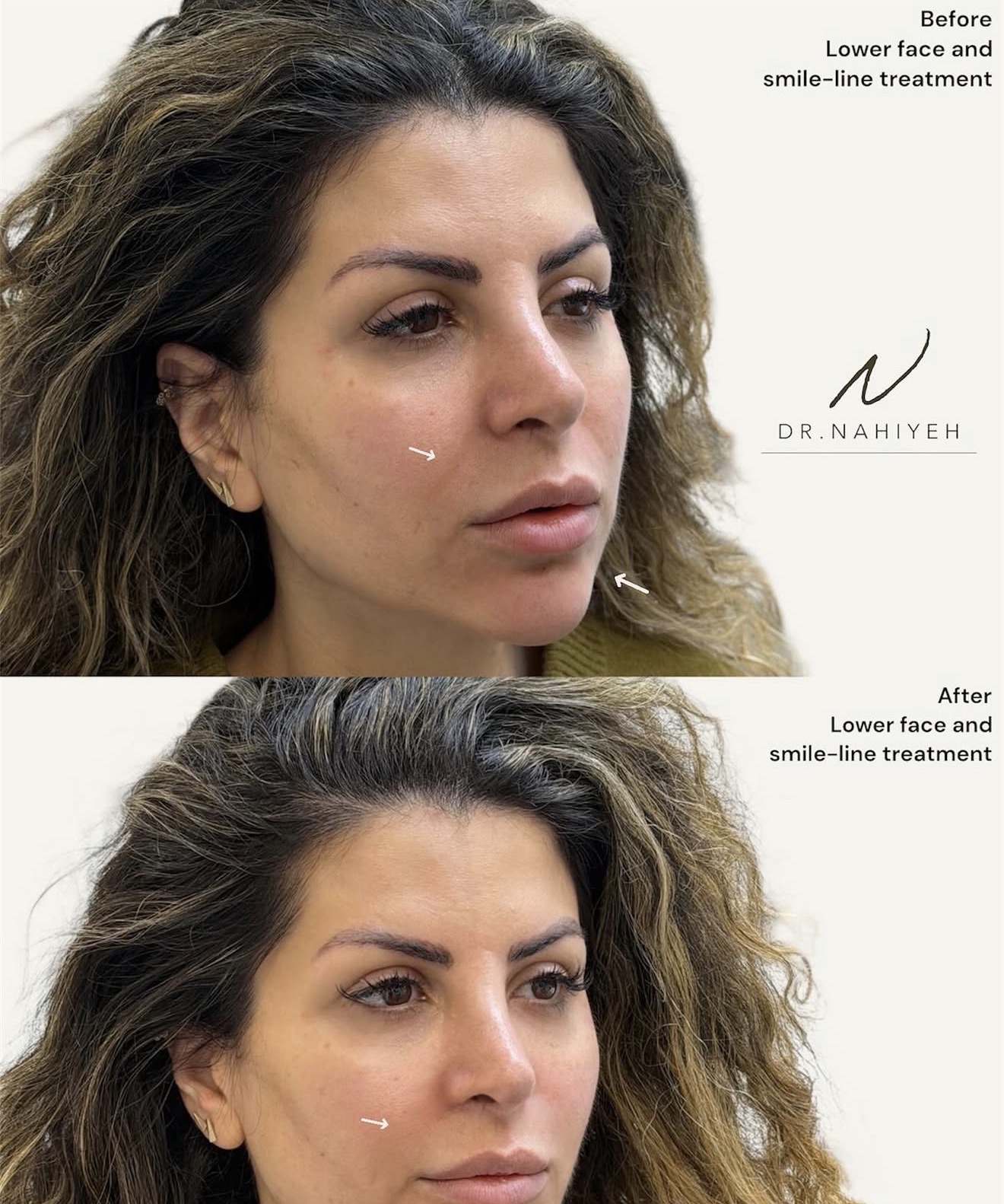 Lower Face & Smile-Line Treatment — image 1