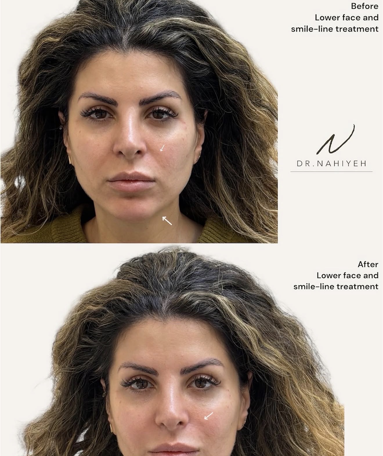 Lower Face & Smile-Line Treatment — image 2