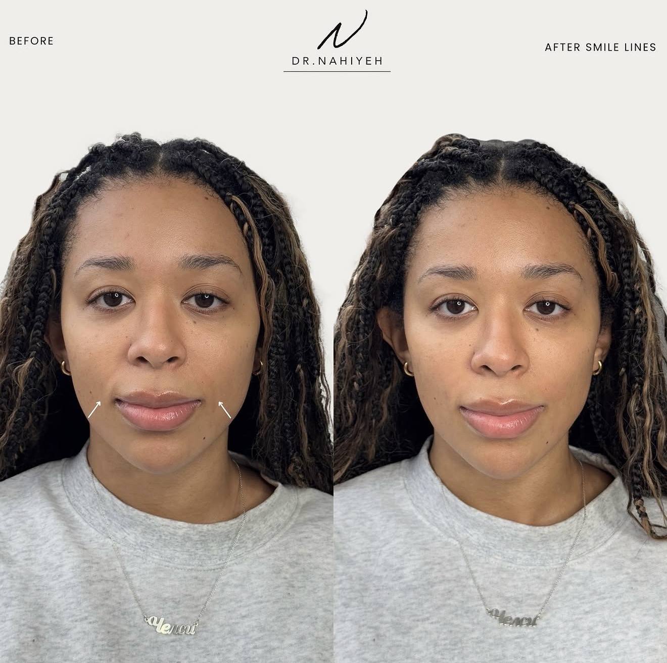 Smile Line Correction — image 1