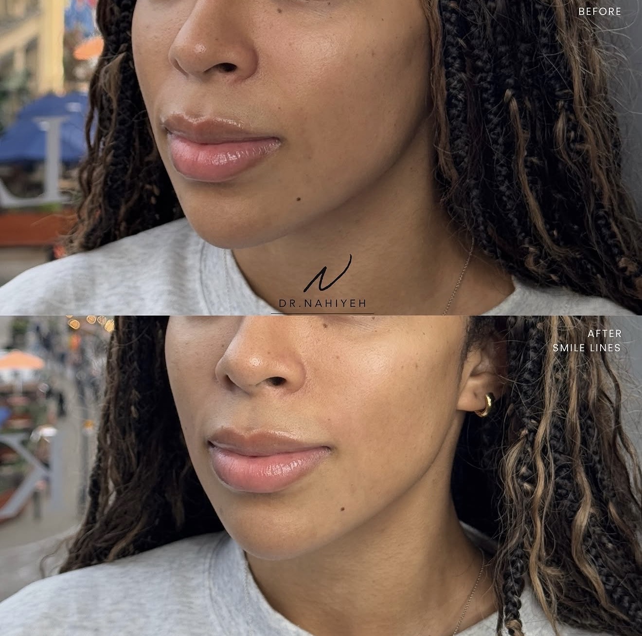 Smile Line Correction — image 2