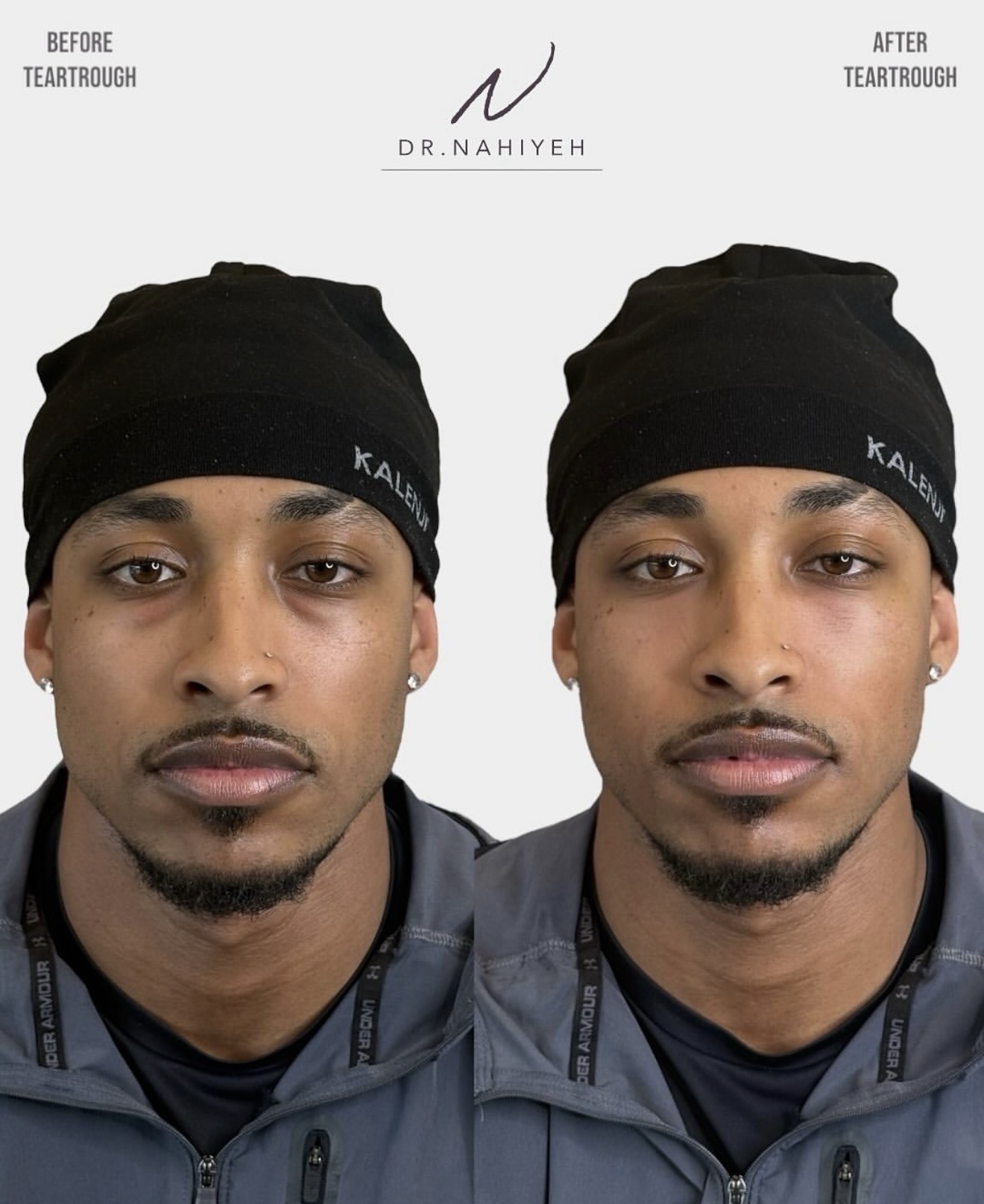 Before and after — Dr. Nahiyeh