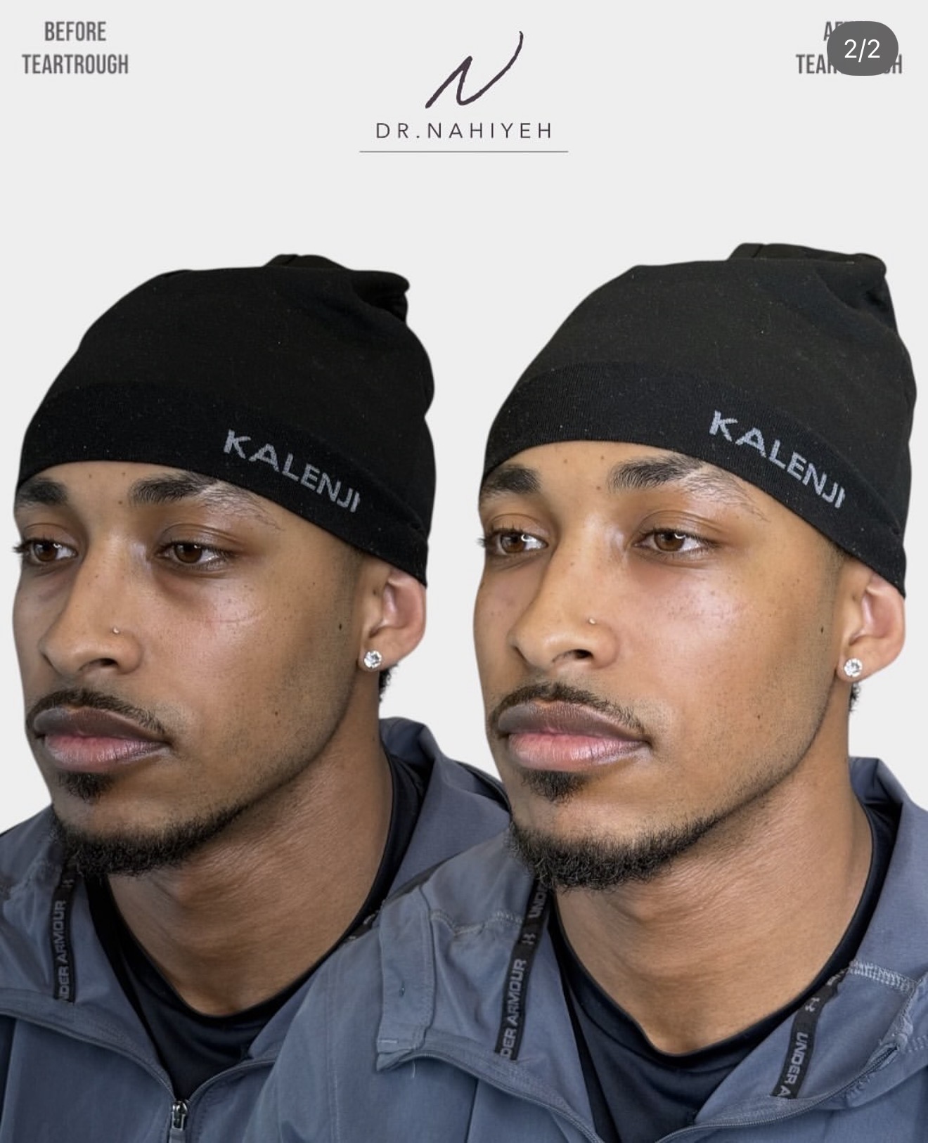 Tear-Trough Rejuvenation — Male Patient I — image 2