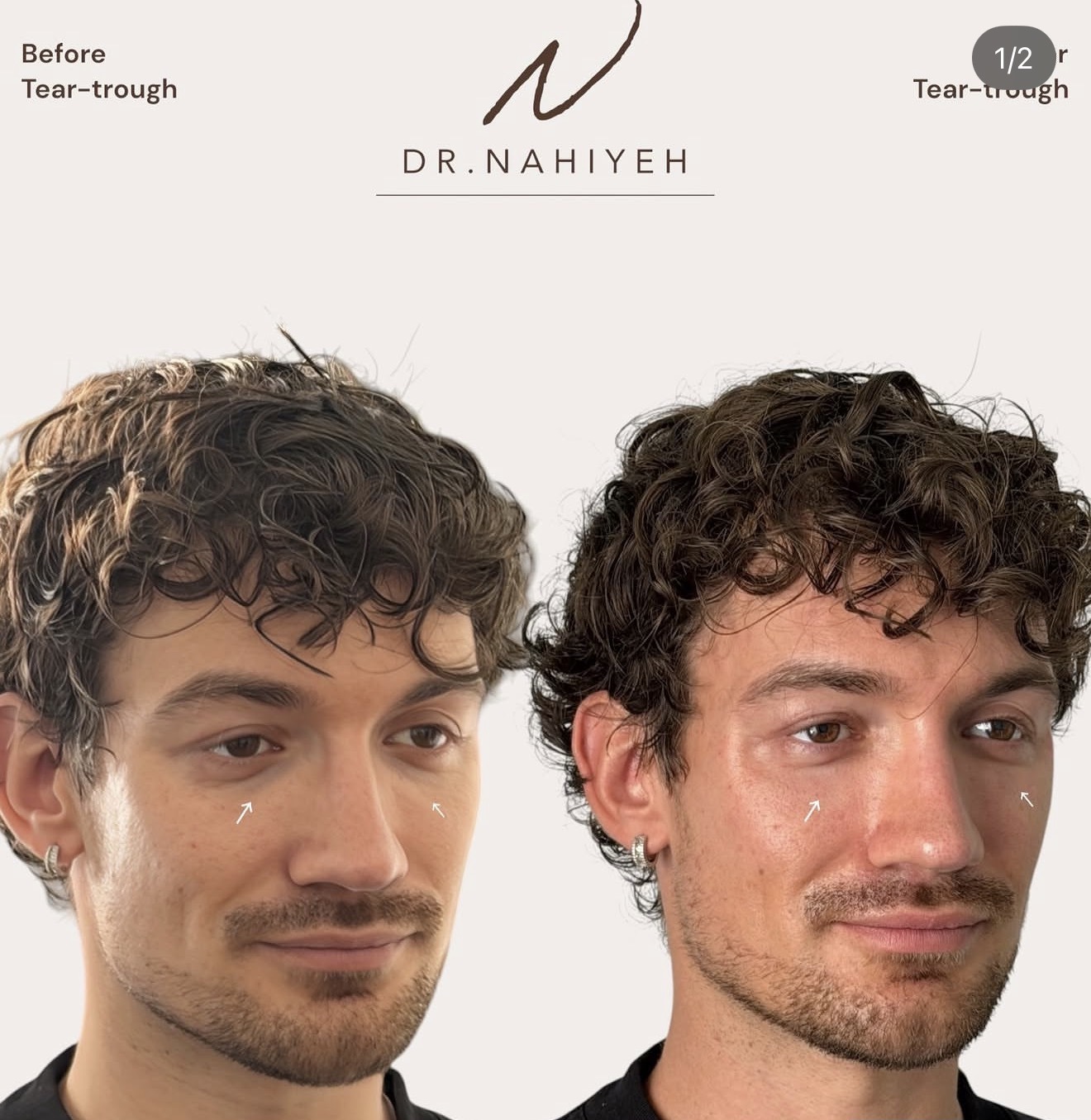 Tear-Trough Rejuvenation — Male Patient II — image 1