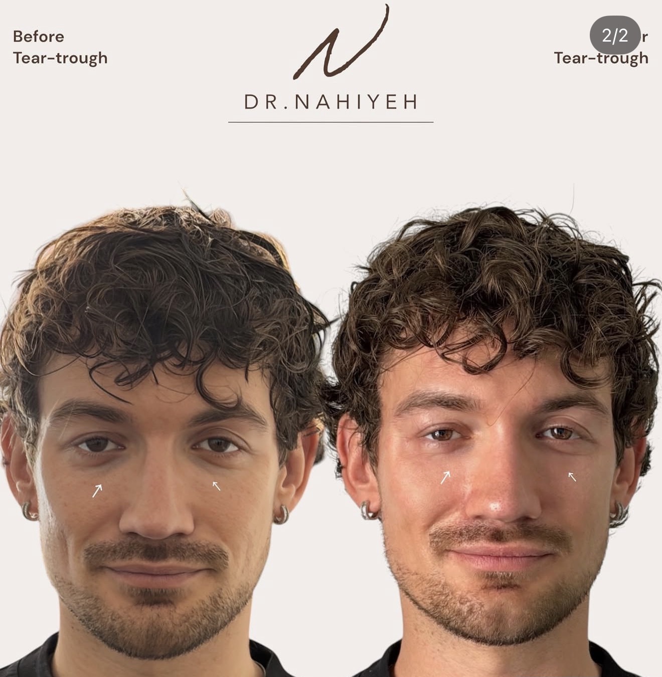 Tear-Trough Rejuvenation — Male Patient II — image 2