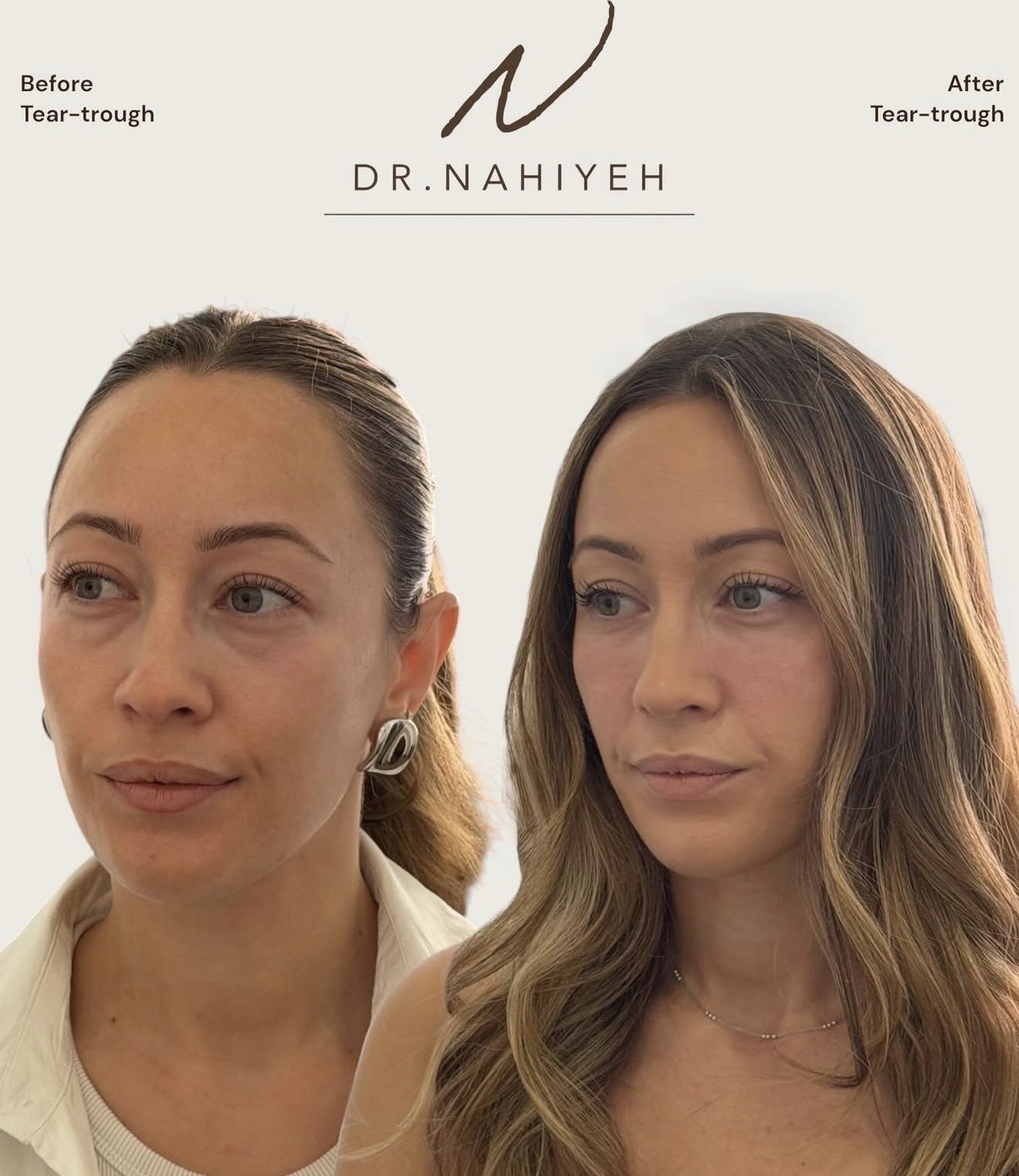 Tear-Trough Rejuvenation — Female Patient — image 1