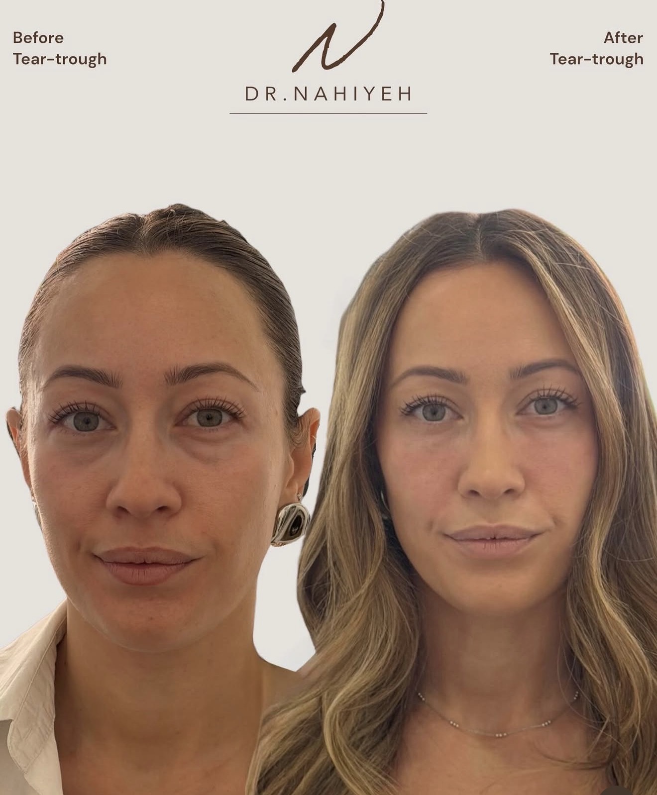 Tear-Trough Rejuvenation — Female Patient — image 2