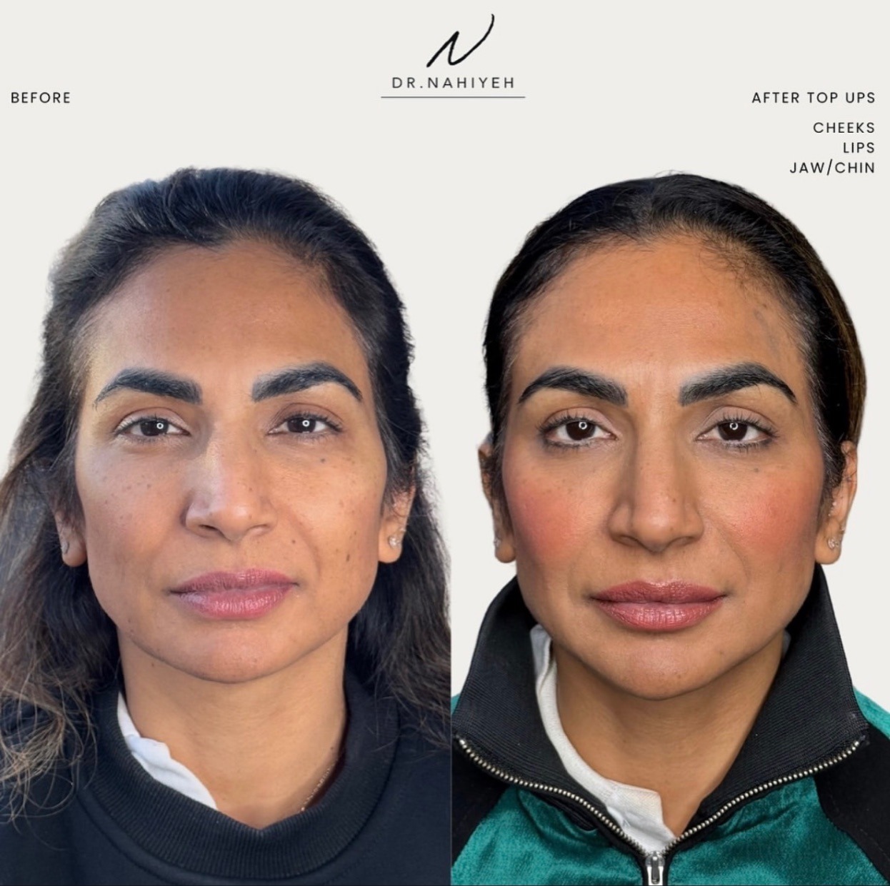 Facial Balancing — Top-Up Results — image 1