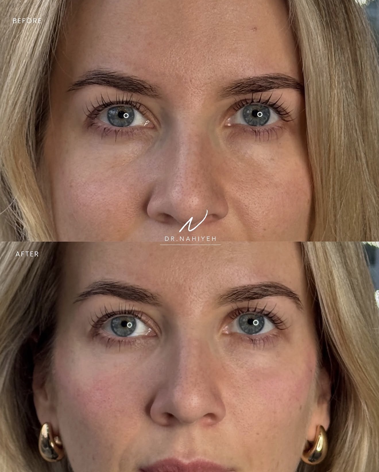 Tear-Trough Filler & Cheek Enhancement — image 2