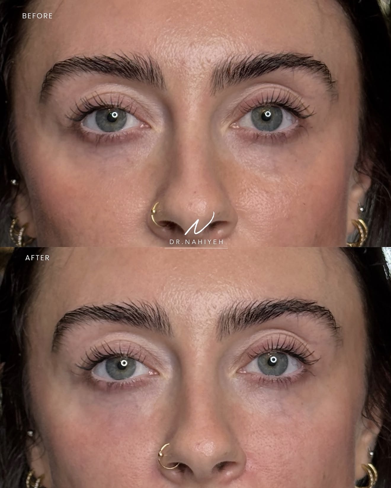 Tear Trough, Pyriform Fossa & Lip Filler — image 2