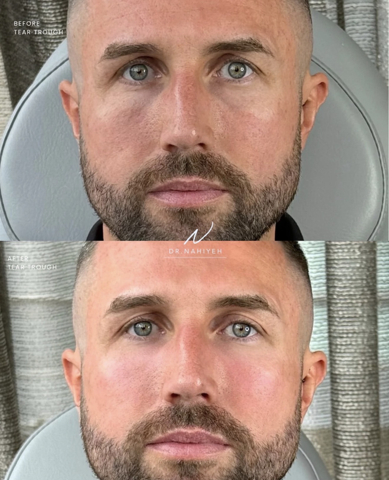 Tear-Trough Rejuvenation — Male Patient III — image 2