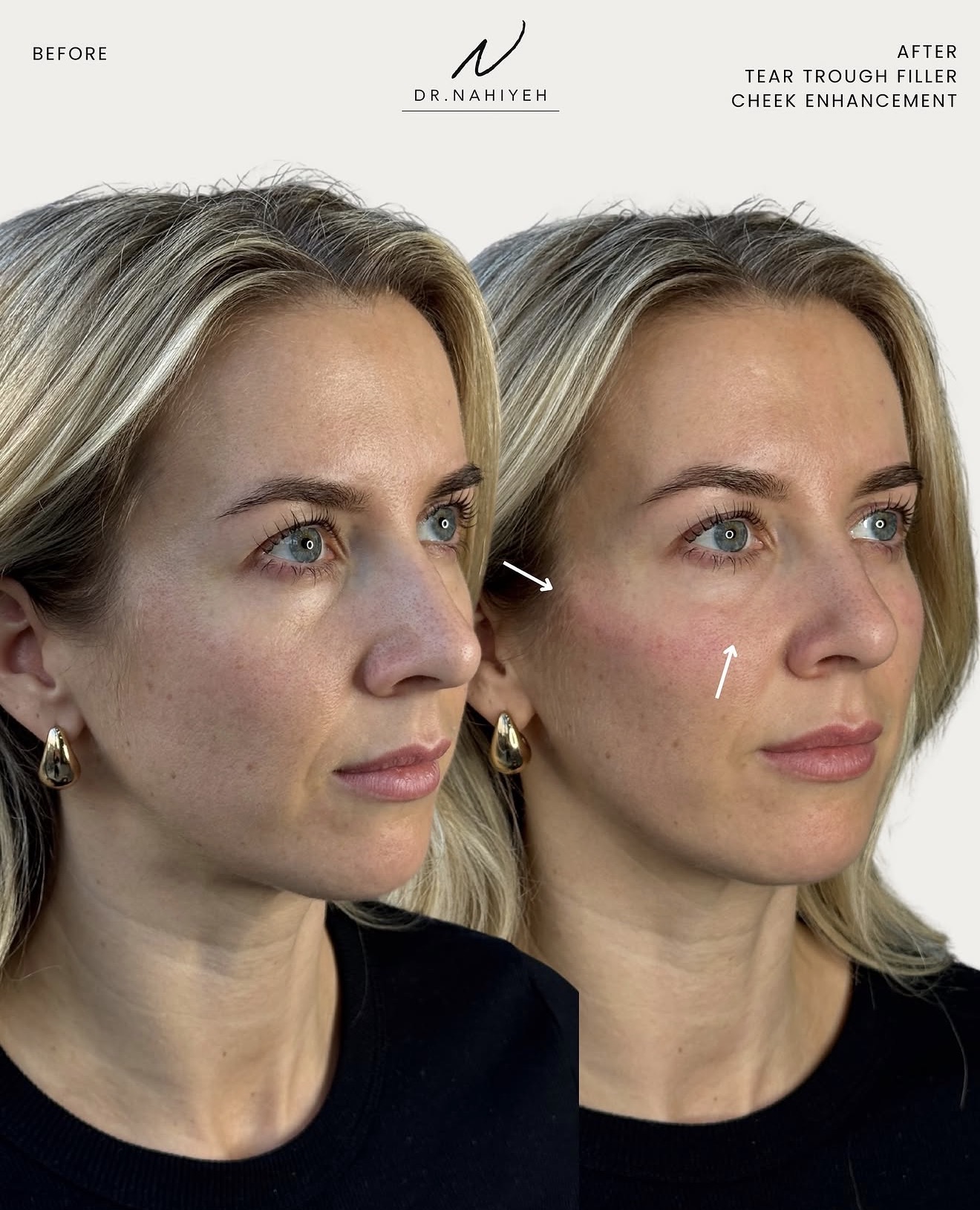 Tear-Trough Filler & Cheek Enhancement — image 1