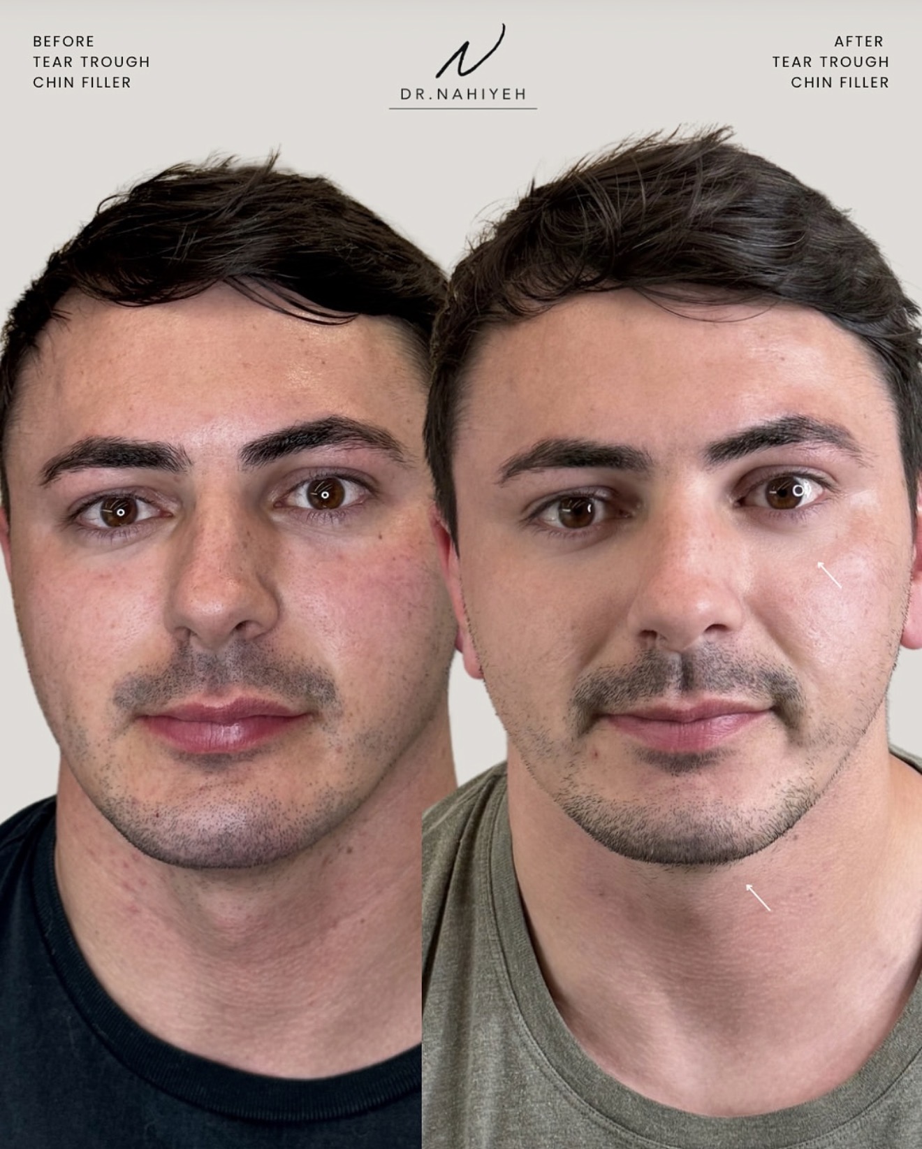 Tear-Trough & Chin Filler — Male Patient — image 1