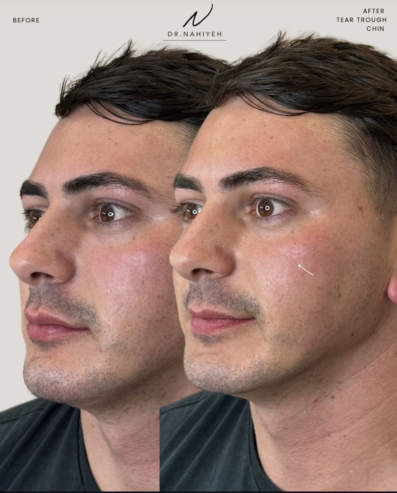 Tear-Trough & Chin Filler — Male Patient — image 2
