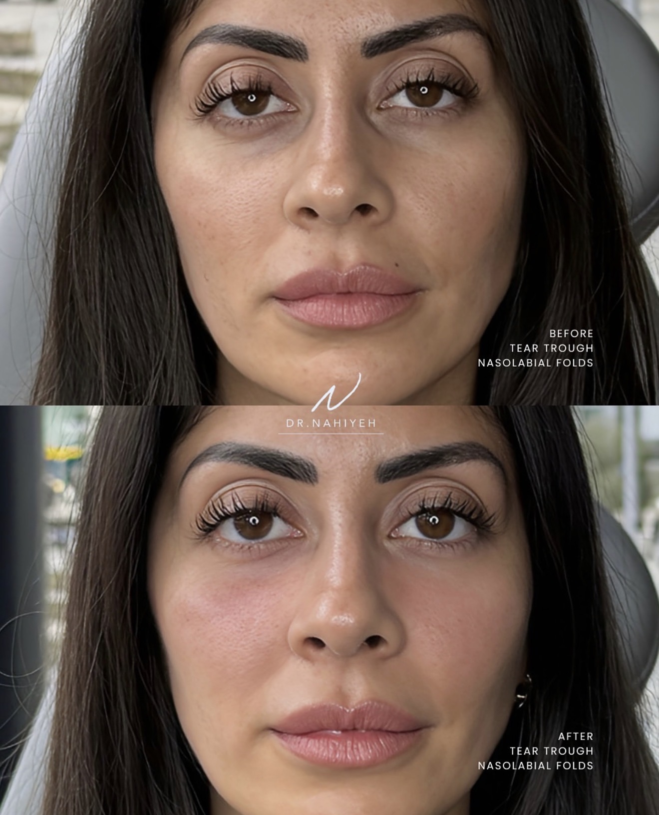 Tear-Trough & Nasolabial Folds — Female Patient — image 1