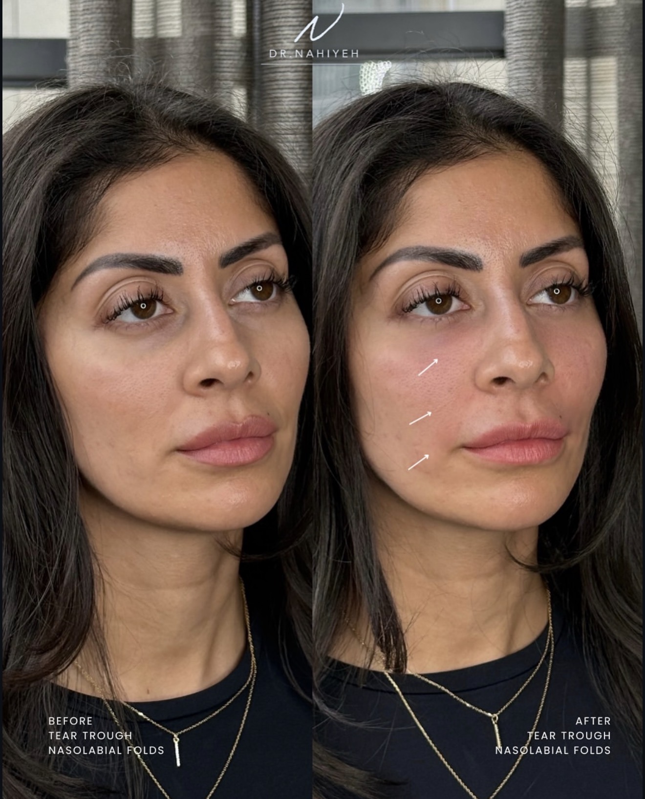 Tear-Trough & Nasolabial Folds — Female Patient — image 2
