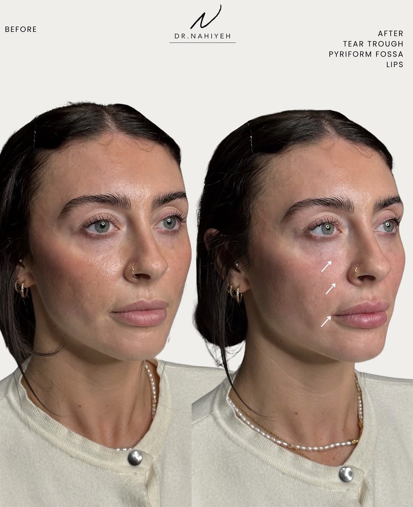 Tear Trough, Pyriform Fossa & Lip Filler — image 1